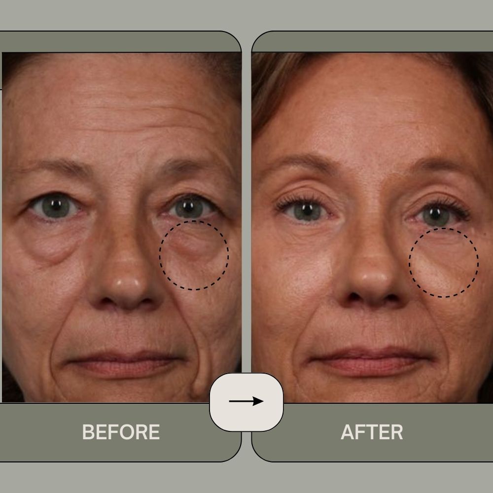 RevitalEyes™️ - Say Goodbye to Puffy Eyes