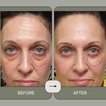 RevitalEyes™️ - Say Goodbye to Puffy Eyes