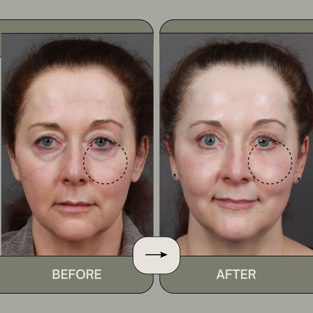 RevitalEyes™️ - Say Goodbye to Puffy Eyes